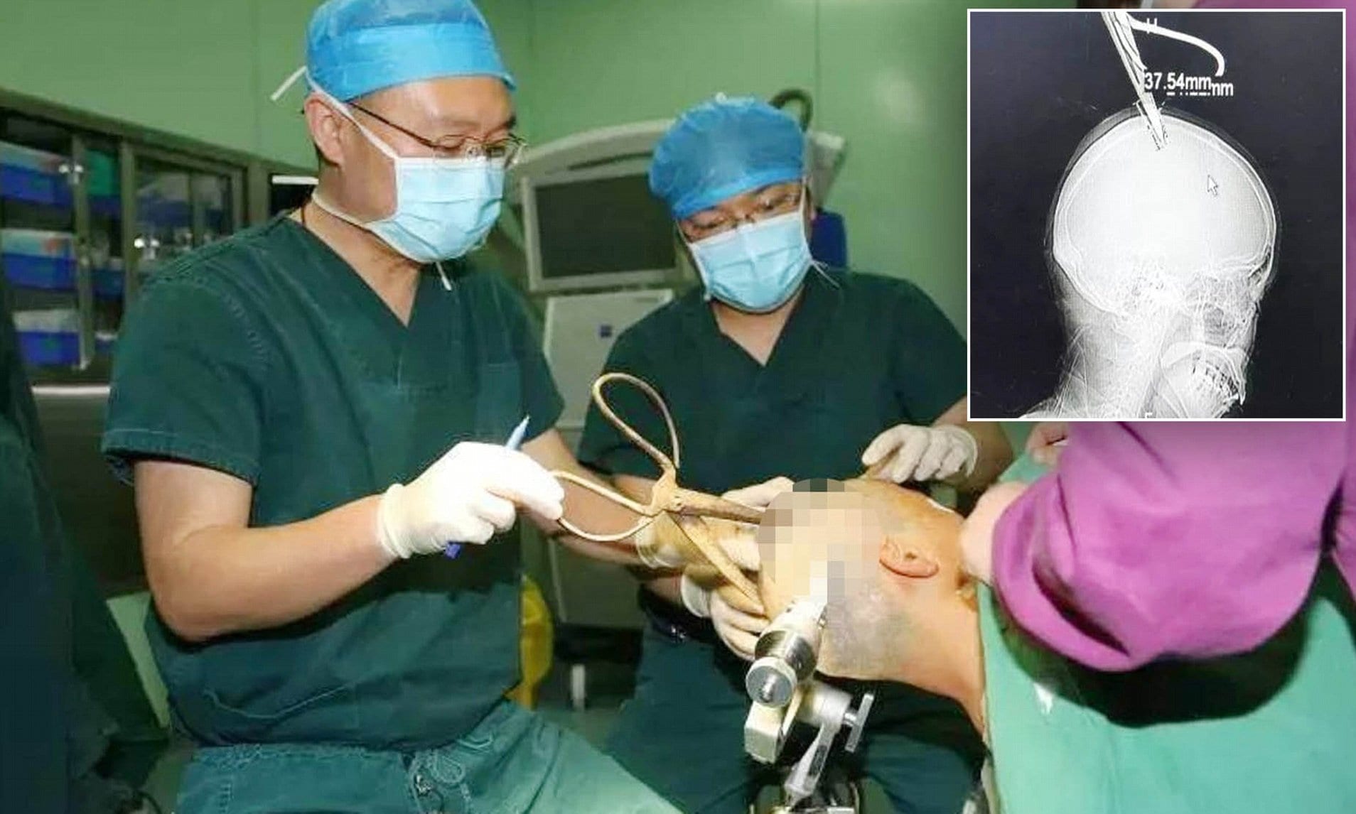بالفيديو.. امرأة صينية تنجو بأعجوبة من استئصال رأسها